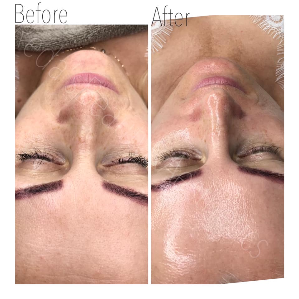 Dermaplaning Teddington Beauty Salon 1 Dermaplaning Teddington Beauty Salon 1