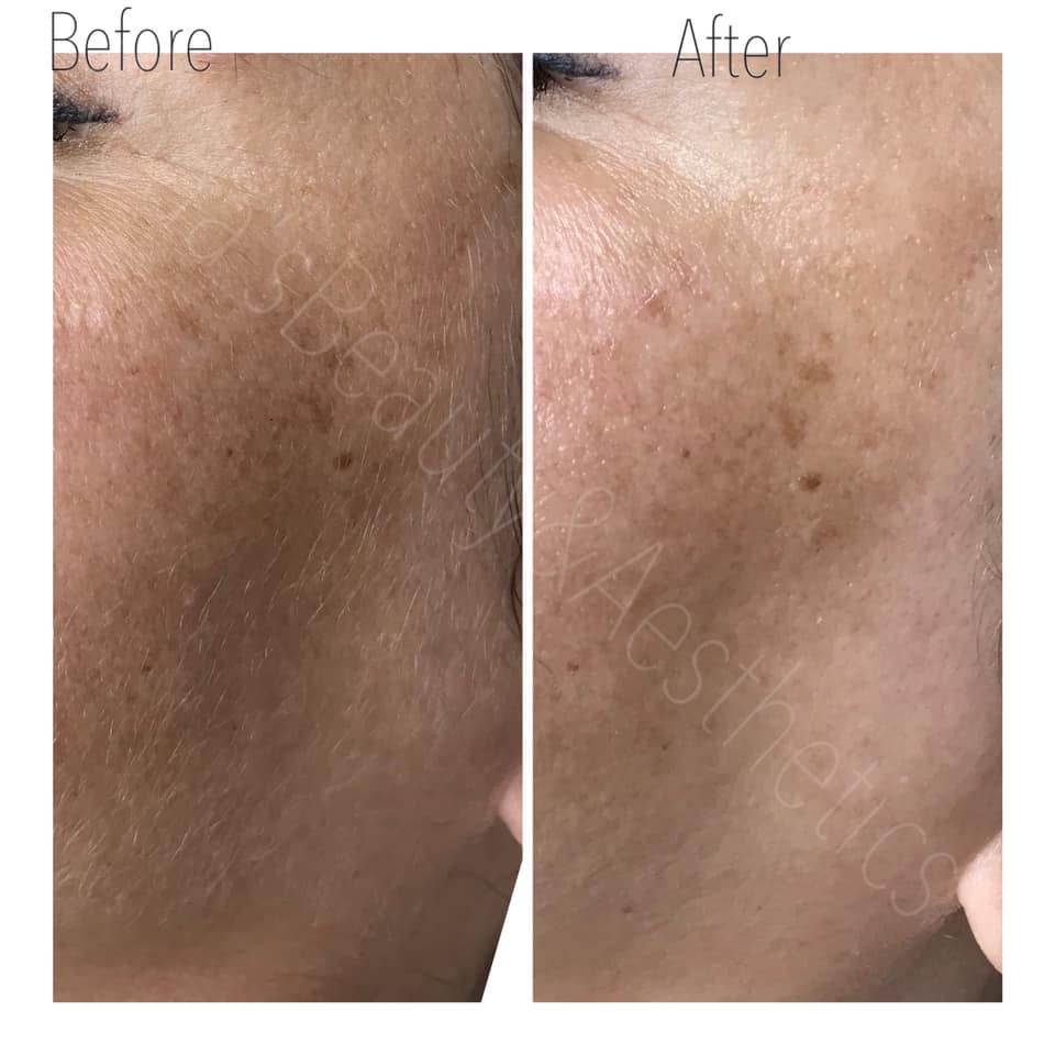 Dermaplaning Teddington Beauty Salon 2 Dermaplaning Teddington Beauty Salon 2
