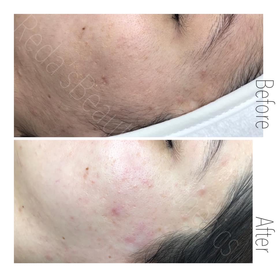 Dermaplaning Teddington Beauty Salon 3 Dermaplaning Teddington Beauty Salon 3