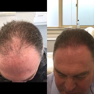 Micropigmentation to cover hair loss