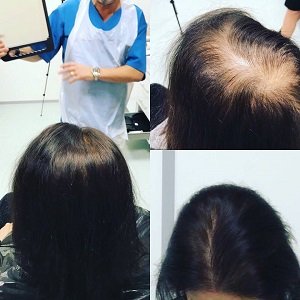 Micropigmentation to cover hair loss in women
