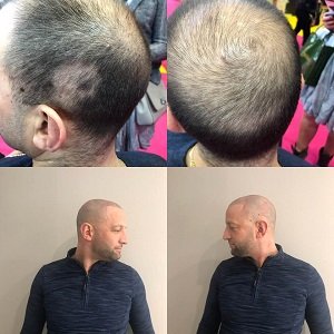 Cover thinning hair with micropigmentation