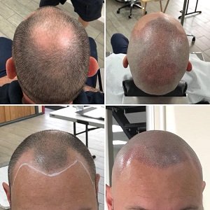 Disguise hair loss with scalp micropigmentation