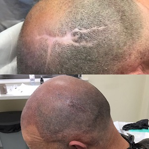 Micropigmentation to cover scarring at Shape Hair Design Teddington