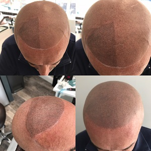 Micropigmentation examples